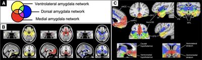 Frontoamygdala hyperconnectivity predicts affective dysregulation in adolescent moderate-severe TBI